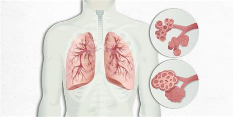 fibrosis pulmonar - nodulo pulmonar
